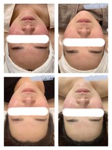 オプレア 千種店(OPREA)/【比較写真】肌質改善