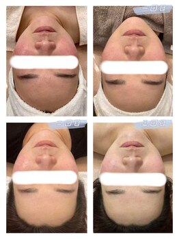 オプレア 千種店(OPREA)/【比較写真】肌質改善