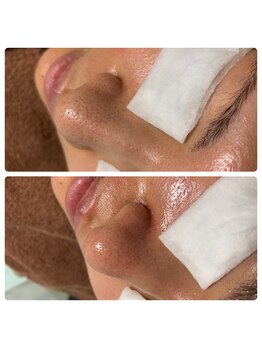 シャナ(Shana)/毛穴洗浄+カーボキシー