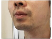 クラフト フェリーチェ 横芝店(CRAFT×felice)/ひげ脱毛、20代男性