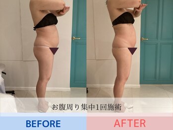 エル 麻布十番(LllL)/【痩身】お腹周り集中1回の効果