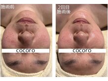 ココロ(COCORO)/カーボキシーで脂肪燃焼効果！