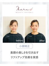 イカル 池袋(ikaru)/小顔矯正 before after 