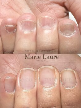 マリーロール 梅田店(Marie Laure)/深爪矯正/自爪育成/ネイルケア