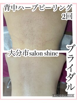 サロンシャイン(Salon Shine)/背中ハーブピーリング2回