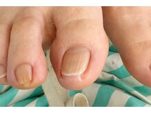 フットジェルの際もしっかりケアと巻爪予防カットをしていきます