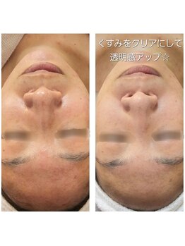 サロン ド ボーテ プルーラ(Salon de beaute PLURA)/新メニュー!ソフトダーマ