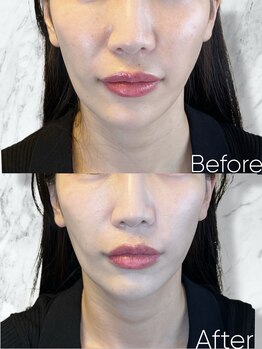 ルミライ(Lumirai)/小顔+ハリツヤUP