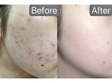 【毛穴|ハーブピーリング】韓国肌管理Belle 綱島【12/10オープン(予定)】の雰囲気(【ニキビ悩みゼロへ】ニキビの原因を根本から改善☆艶肌へ!)