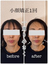 リバイブ 自由が丘店(REVIVE)/小顔矯正+ドライヘッドスパ1回