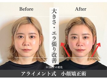 アライメントトウキョウ 表参道(Alignment TOKYO)/大きさ・エラ張り