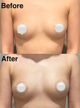 リレイスフクオカ(RelaceFUKUOKA)/バストアップ脂肪増加剤