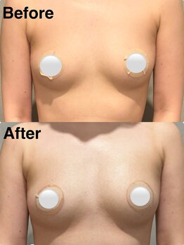 リレイスフクオカ(RelaceFUKUOKA)/バストアップ脂肪増加剤