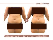 イエス マイサロン(yes My Salon)/ハーフ痩身トリートメント症例