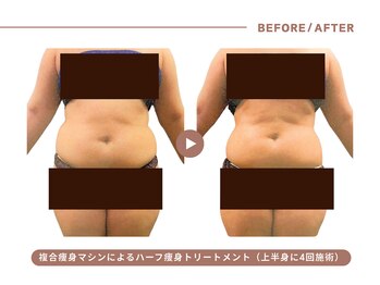 イエス マイサロン(yes My Salon)/ハーフ痩身トリートメント症例
