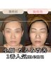 【深刻なたるみ/小顔に】35歳以上の疲れ顔改善【肩甲骨～頭頂部】25000円