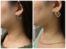 ナチュライズ(NatuRise)/首シワ改善