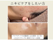 BUB 立川/ニキビ予防したい方へ