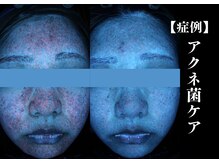 The水光美肌専科/ニキビケア