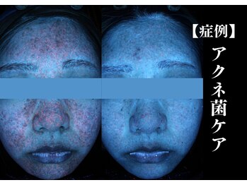 The水光美肌専科/ニキビケア