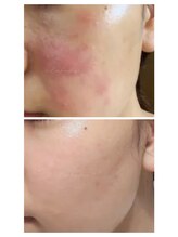 ミーラブ 鹿児島(miilove)/敏感肌・赤み・肌荒れケア