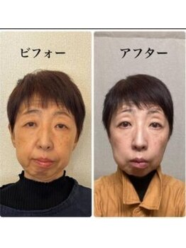 シェノン(CHAINON)/小顔/リフトアップ/松阪市/津市