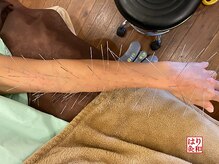 はりきゅう和 ルート鍼灸院/しんどい腕、手