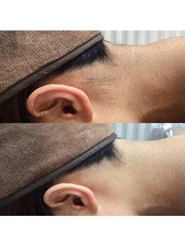 エステティック レイビス 池袋店(RAYVIS)/うなじ脱毛