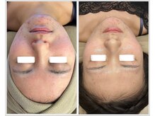 美しぐれ 溝の口店/【1ヶ月】MTS/LDM/ピーリング