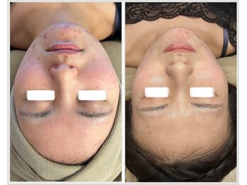 美しぐれ 溝の口店/【1ヶ月】MTS/LDM/ピーリング