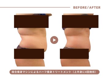 イエス マイサロン(yes My Salon)/ハーフ痩身トリートメント症例