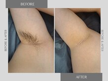 テリー(Terry)/メンズ脱毛before after 5回照射