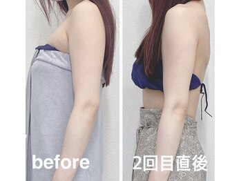 ハロ 南青山(HALO)/レモンボトル二の腕モニター様