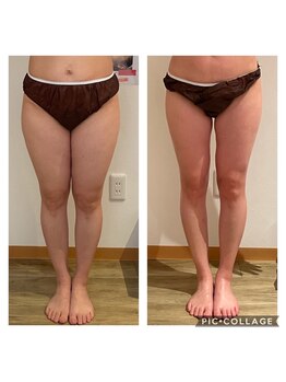 サロン ド モナ(salon de mona)/【ビフォーアフター】脂肪冷却！