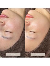 タグ 高知駅前店(Tug)/ニキビケア・跡・毛穴