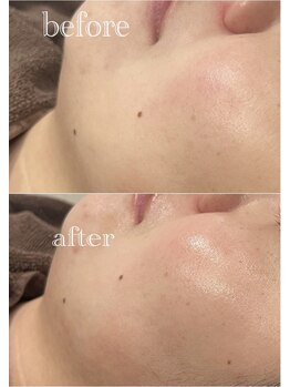 ツール(TOOL)/ハーブピーリング