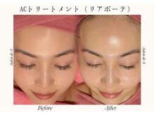 サロンドエー 帝塚山(Salon de A)/ACトリートメント