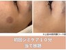 まずは相談してみる♪初回シミ集中ケア10分当て放題　6950円→4950円