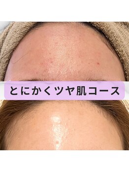 ホワイトニングジム アイス/お肌に合う2種類のピーリング