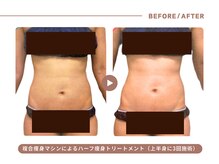 イエス マイサロン(yes My Salon)/ハーフ痩身トリートメント症例