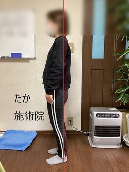 たか施術院/首こり 背中の痛み 20代 学生