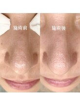 シアー(sHeeR)/毛穴ケア