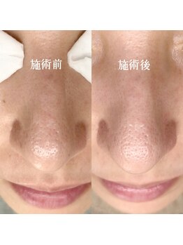 シアー(sHeeR)/毛穴ケア