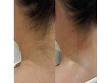 イードットアイブロウサロン(E.eyebrow salon)の雰囲気（Wax脱毛でうなじツルツル☆夏のアップスタイルも引き立てる◎）