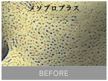 ダイヤモンド リーエンダ(Diamond leende)/メソプロプラス