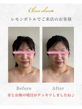 シュシュ(Chouchou)/レモンボトル1回