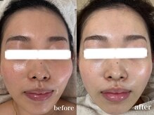 リアルナ(REALUNA)/赤ら顔／乾燥肌