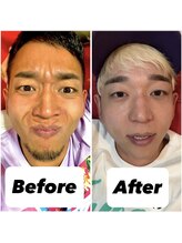 アイリス(IRIS)/アゴ脱毛 Before After