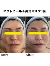 マーレン(Malen)/ダクトピール症例写真