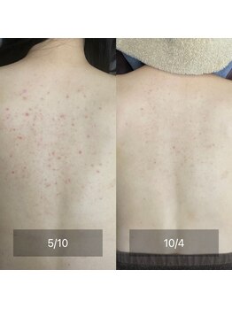 エクラルム(Eclaleum)/BeforeAfter　背中ピーリング